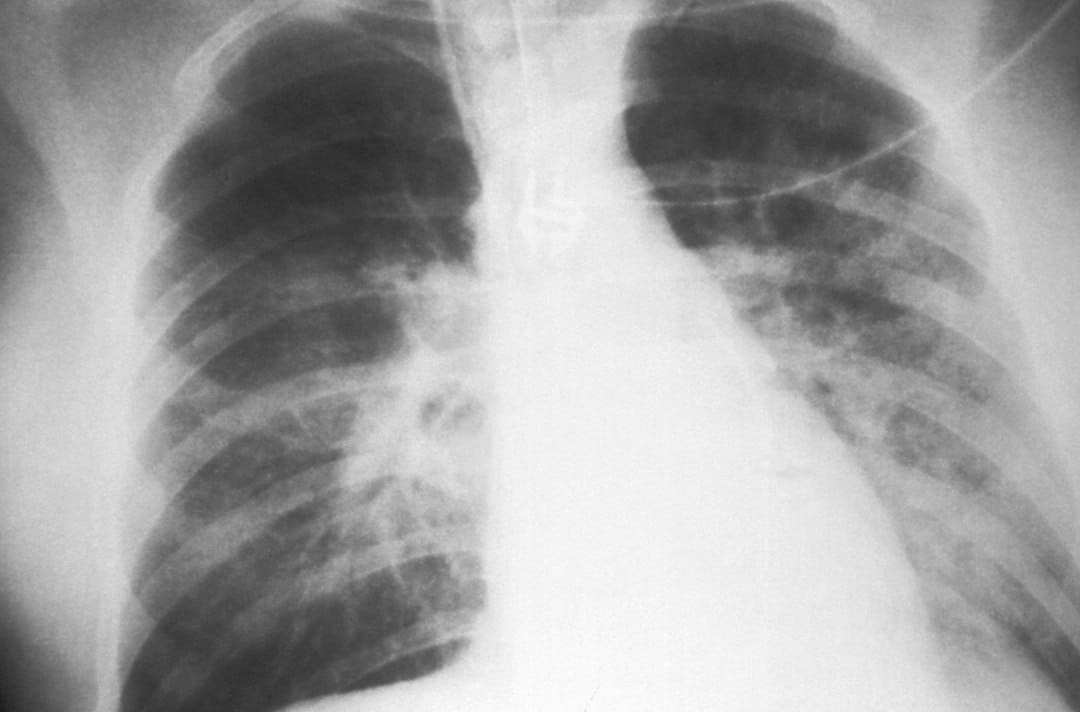 Fábricas de aerosoles con gases propelentes: la lata que se convierte en proyectil bajo calor